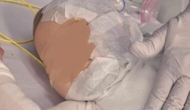 Brisbane mum calls for justice one year after baby scalded with hot coffee