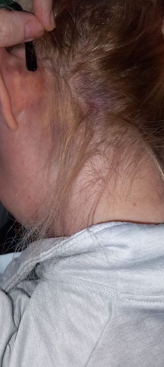 Martina Maguire shows bruises to her head and legs and (bottom) the slashed tyres on her car