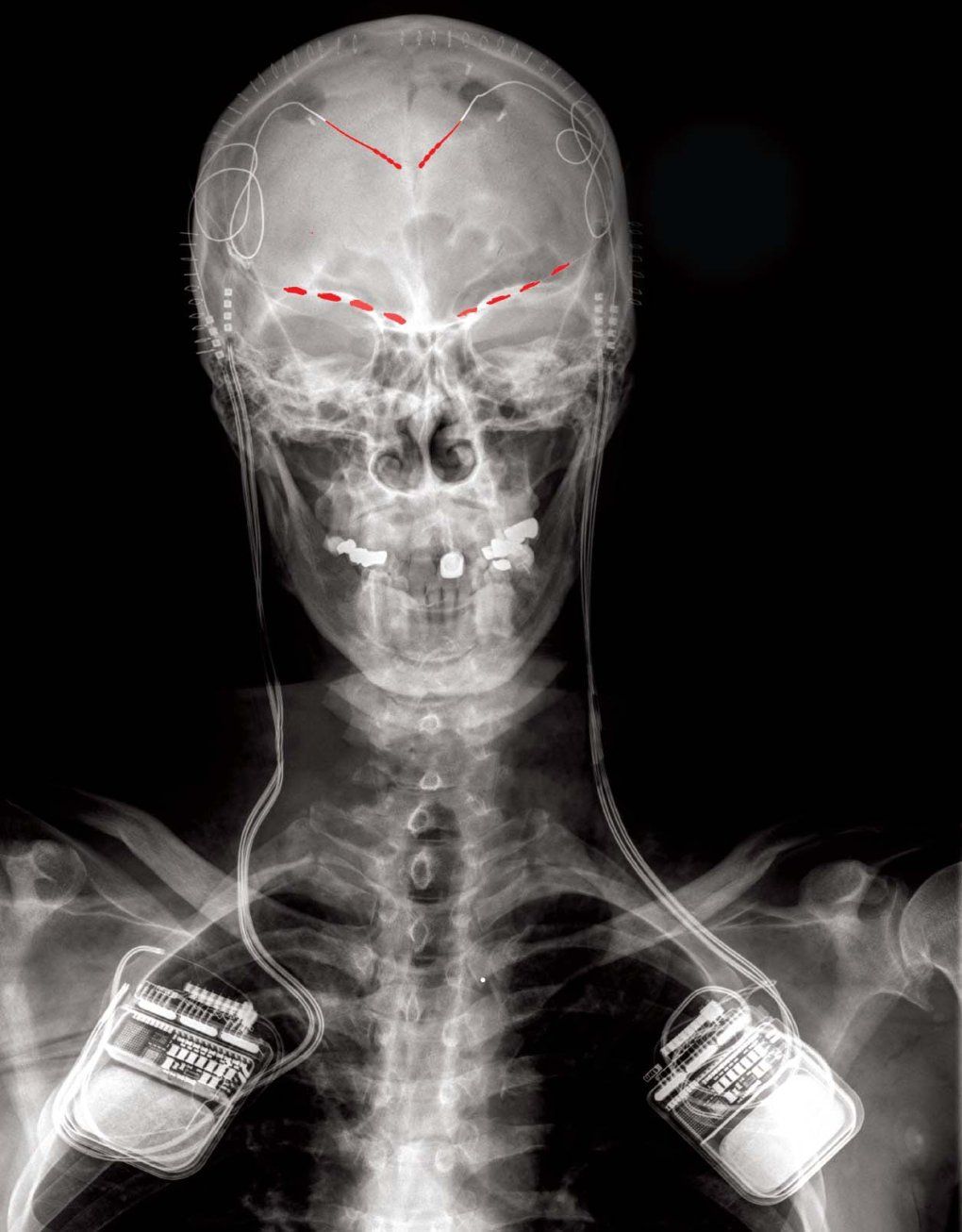 An x-ray of a study participant shows two devices at their left and right shoulders extending wires up into their skull