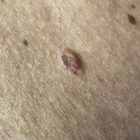 Jak Howells Jak Howells's melanoma found on his back