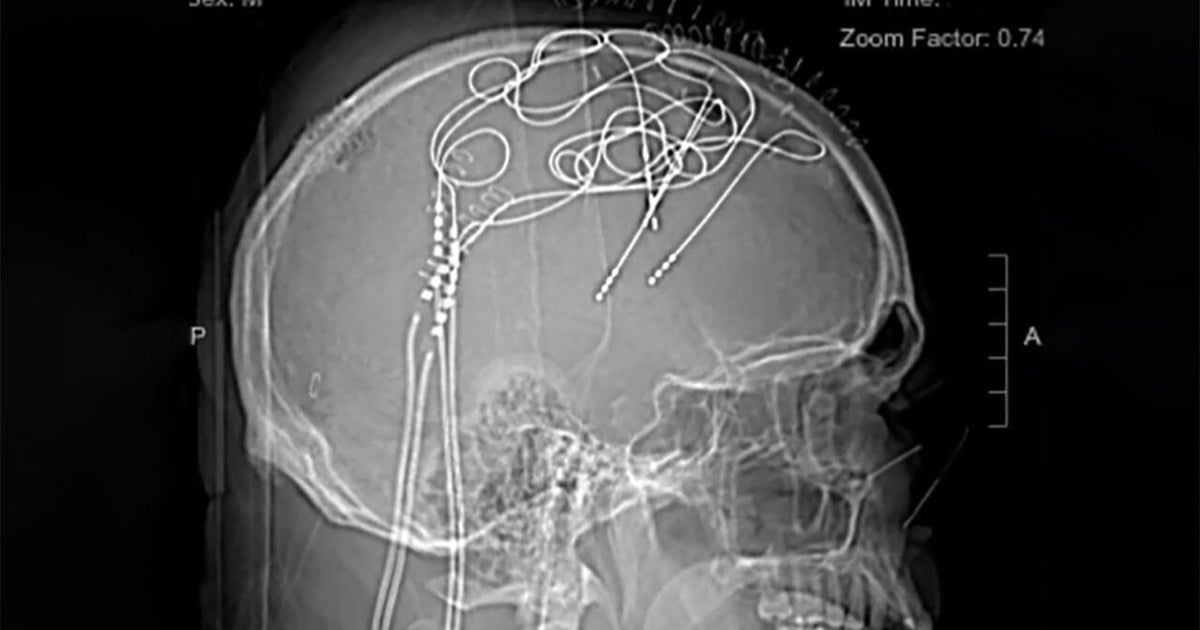 Dr. Sanjay Gupta on the mysteries of chronic pain