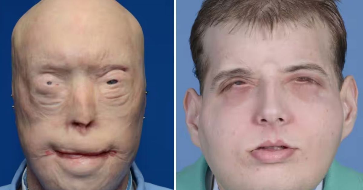 Today in History - August 14: Epic operation gives injured firefighter a new face