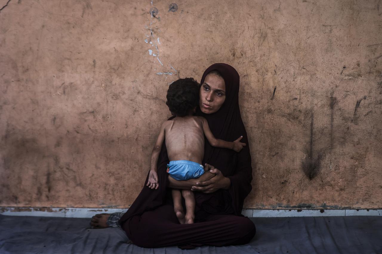 2-year-old Palestinian Yezen Abu Ful, whose health has deteriorated due to lack of access to food and nutritional supplements, is seen with his mother in the Al-Shati Refugee Camp in Gaza Strip on July 24, 2025. (AA Photo)