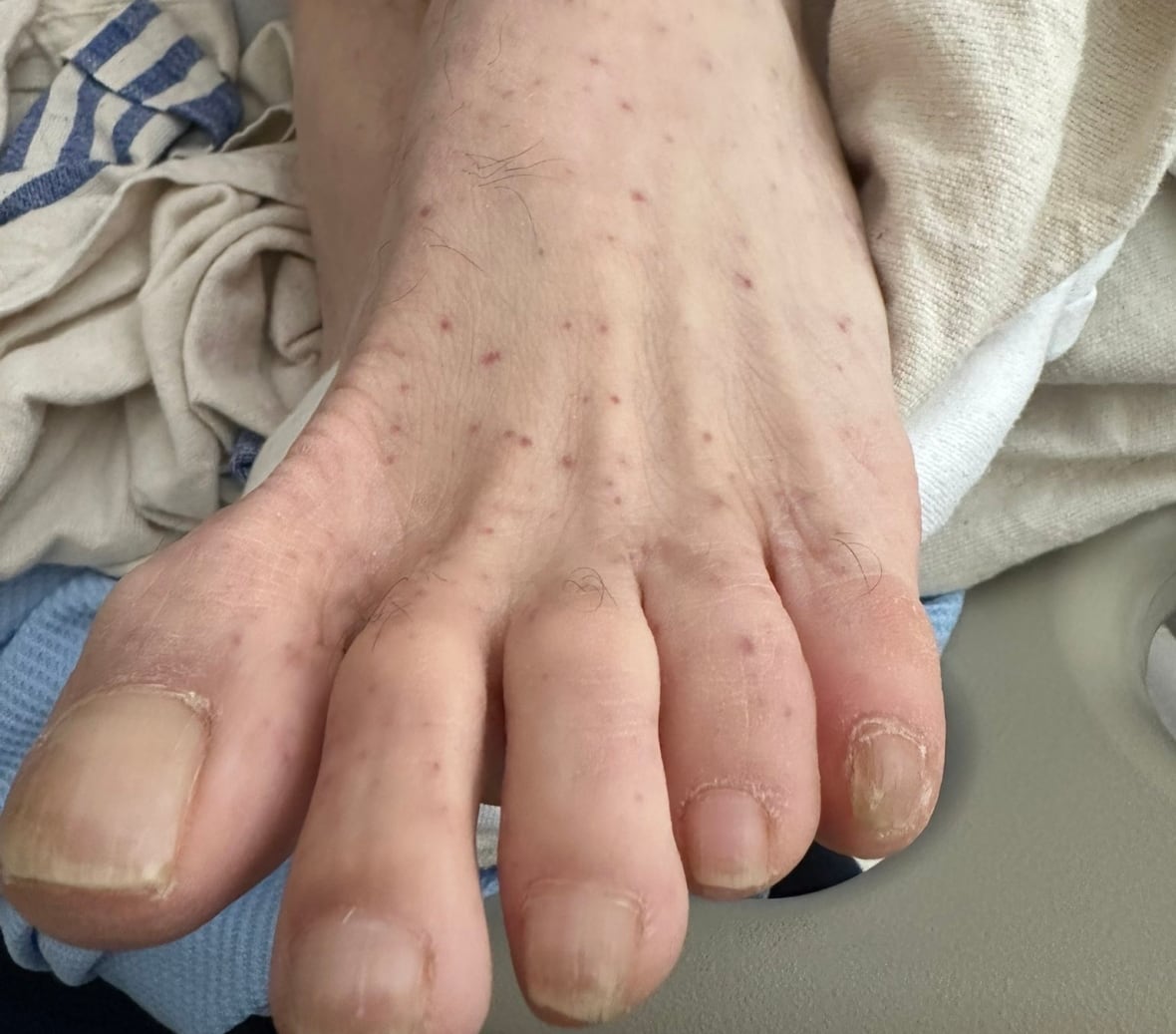 Foot with spotty rash