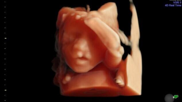 What causes cleft lip and palate? A genetic clue emerges