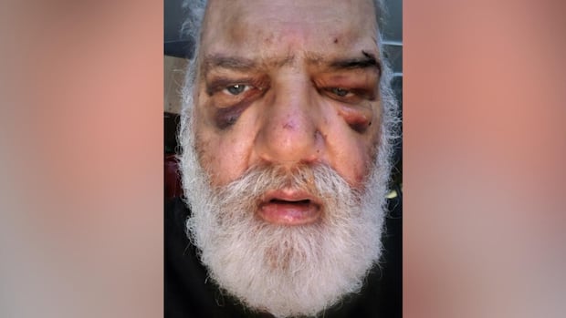 'Brutal and senseless assault' leaves senior with multiple injuries on Vancouver Island