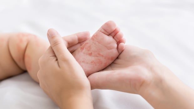 N.S. child admitted to the IWK with measles