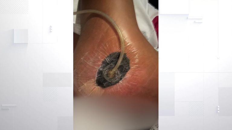 Louise was unable to walk after the liquid BBL procedure