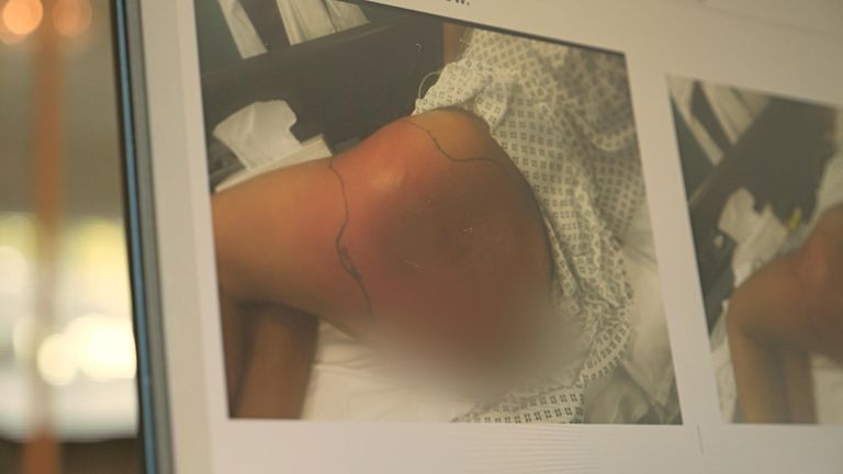 Louise developed sepsis following the procedure