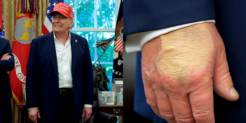 Donald Trump Pictured with Makeup Covering His Right Hand After Doctor’s Recent Comments About Bruising | Donald Trump | Just Jared: Celebrity News and Gossip