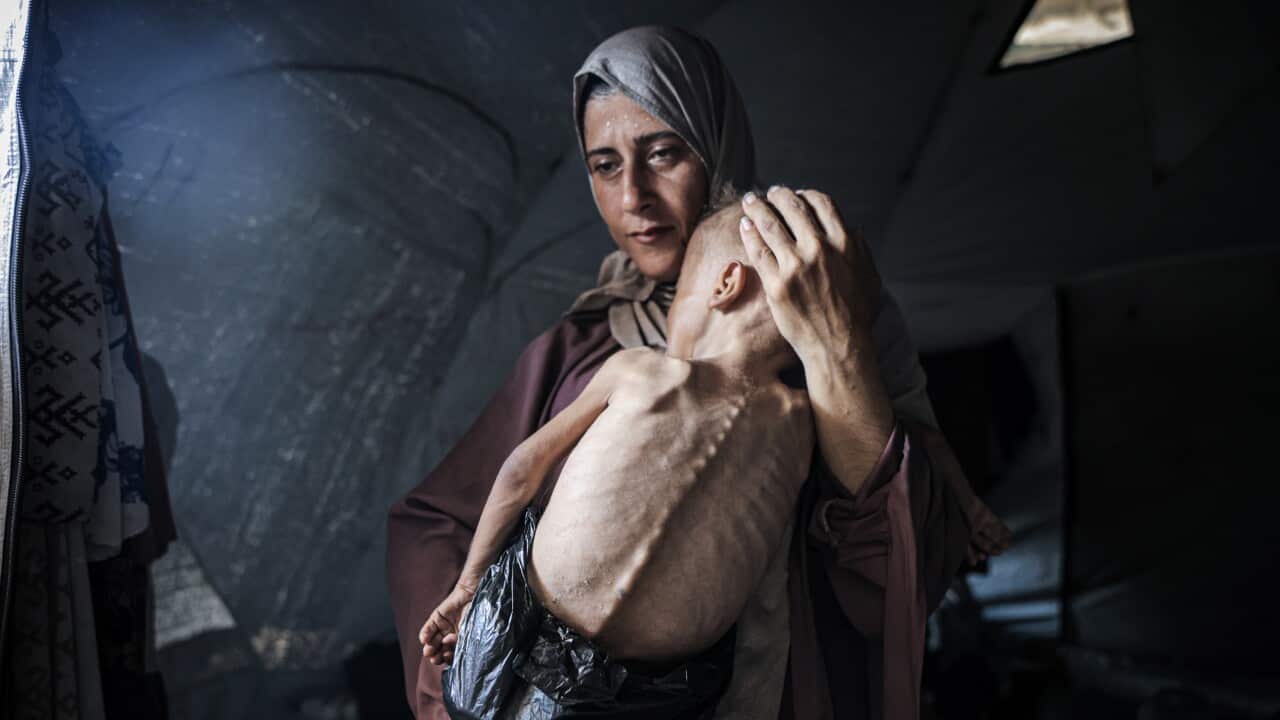 A woman holding a malnourished child in her arms.