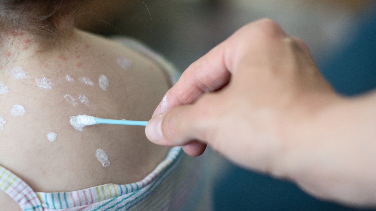 Chickenpox vaccine to be made free for children aged one