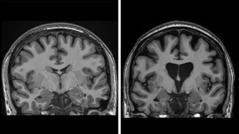 UCLH The images show two cross sections of the human brain in black and white side- by-side. You can see the semi-circular outline of the skull. Inside is the folded brain matter. The key difference between the two images is the greater amount of dark space on the right demonstrating where brain tissue has died.