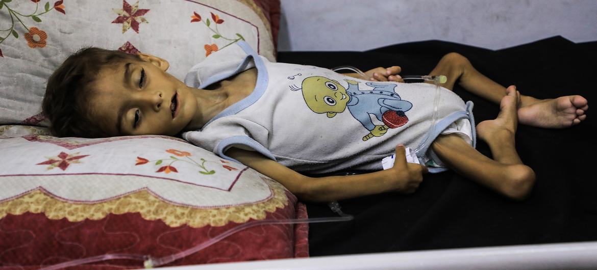 A child suffering from malnutrition lies on a bed in the Patient Society Hospital in Gaza City .