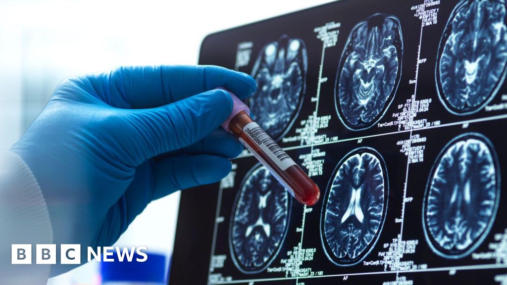 Alzheimer's blood test could 'revolutionise' diagnosis