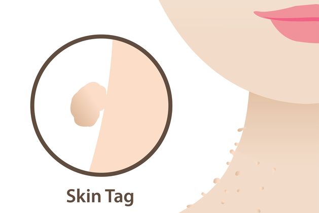 Stay Well: What causes skin tags and how do I get rid of them?