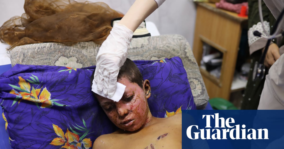 Civilian injuries in Gaza similar to those of soldiers in war zones, study finds | Gaza