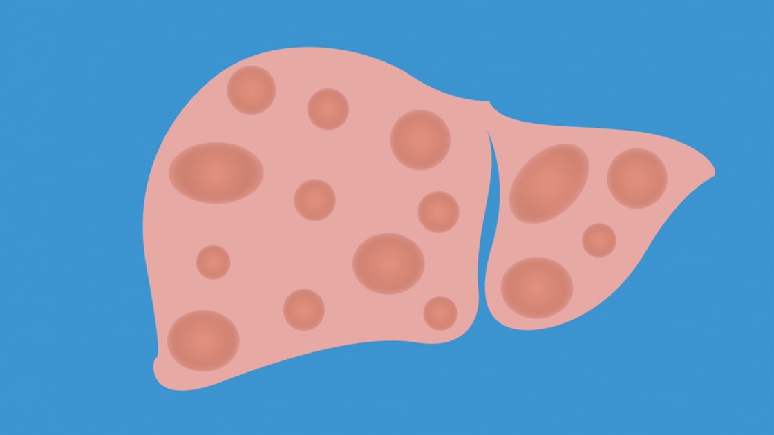 Molecule Shows Promise for MASH, Endometriosis, and Other Chronic Diseases < Yale School of Medicine