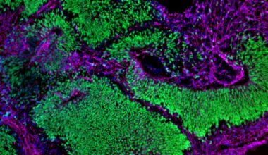 Brain organoid depicting neural stem cells in green and neurons in magenta. Both cell types are abundant, showing normal development.