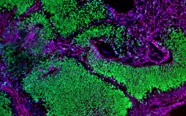 Brain organoid depicting neural stem cells in green and neurons in magenta. Both cell types are abundant, showing normal development.