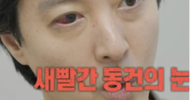 Lee Dong-gun Reveals Rare Genetic Disease Affecting 1% of South Koreans - 조선일보
