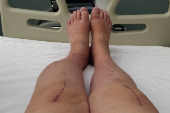 Kim Gollan’s leg grew a lump following a double knee replacement with Dr Al Muderis in 2016.