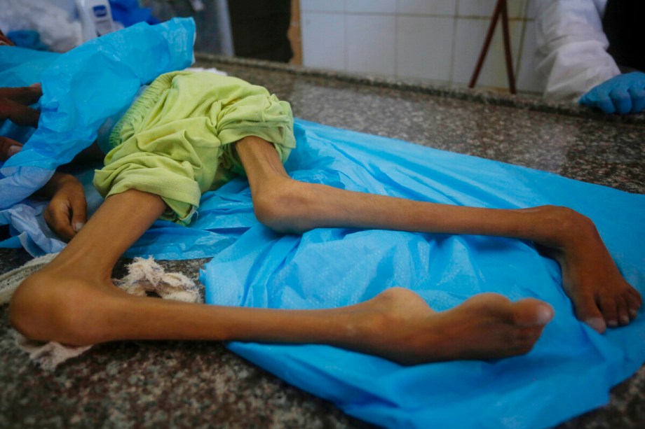 7 more Palestinians including 2 children die of malnutrition in Gaza, taking toll to 420 – Middle East Monitor