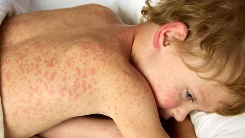 Second child dies of measles in Jerusalem within a week