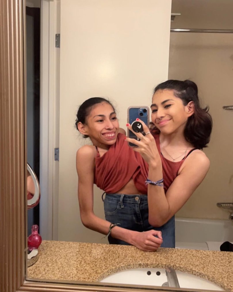 Born in Mexico and now 25, Carmen and Lupita defied the odds by living well beyond doctors’ initial expectations.