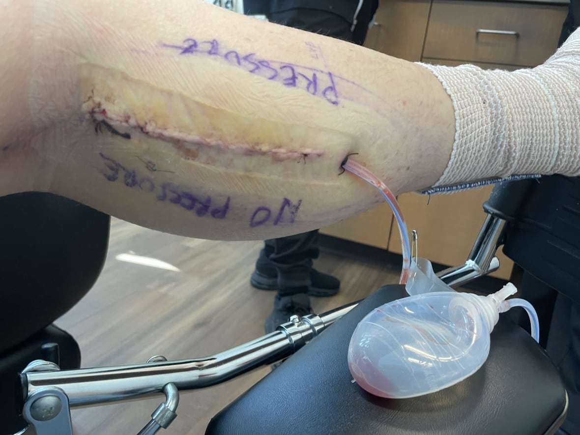 A leg is pictured with a tube coming out of the lower calf. 