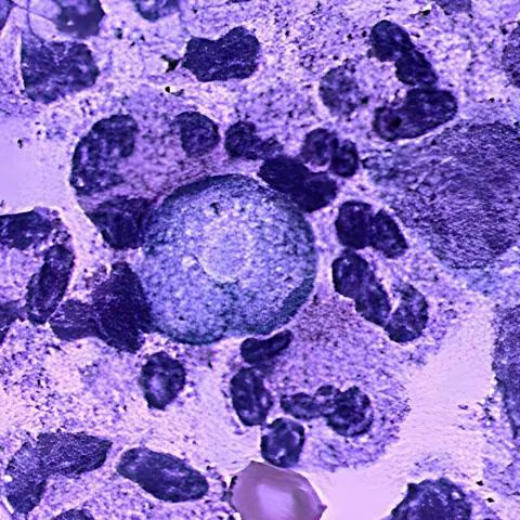 Universal Images Group via Getty Images Naegleria fowleri is an amoeba (one-celled living organism) that lives in soil and warm freshwater, such as lakes, rivers, and hot springs. It is commonly called the brain-eating amoeba because it can cause brain infection when water containing the amoeba rises in the nose. Only about three people in the United States are infected each year, but these infections are usually fatal. (Photo by: CDC/IMAGE POINT FR/BSIP/Universal Images Group via Getty Images)