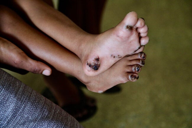 PAHO publishes first guidelines for the treatment of tungiasis, a neglected disease that affects millions - PAHO/WHO