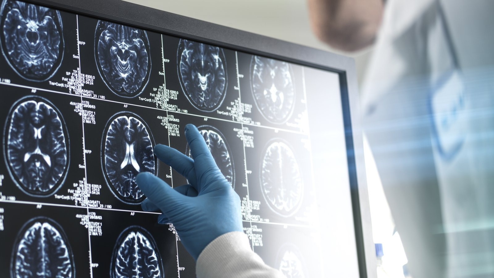 Early menopause associated with increased dementia risk