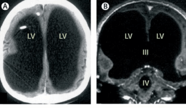 This CT scan belongs to 44 year old French man ‘who lived normal life despite missing 90% of brain’, baffled scientists
