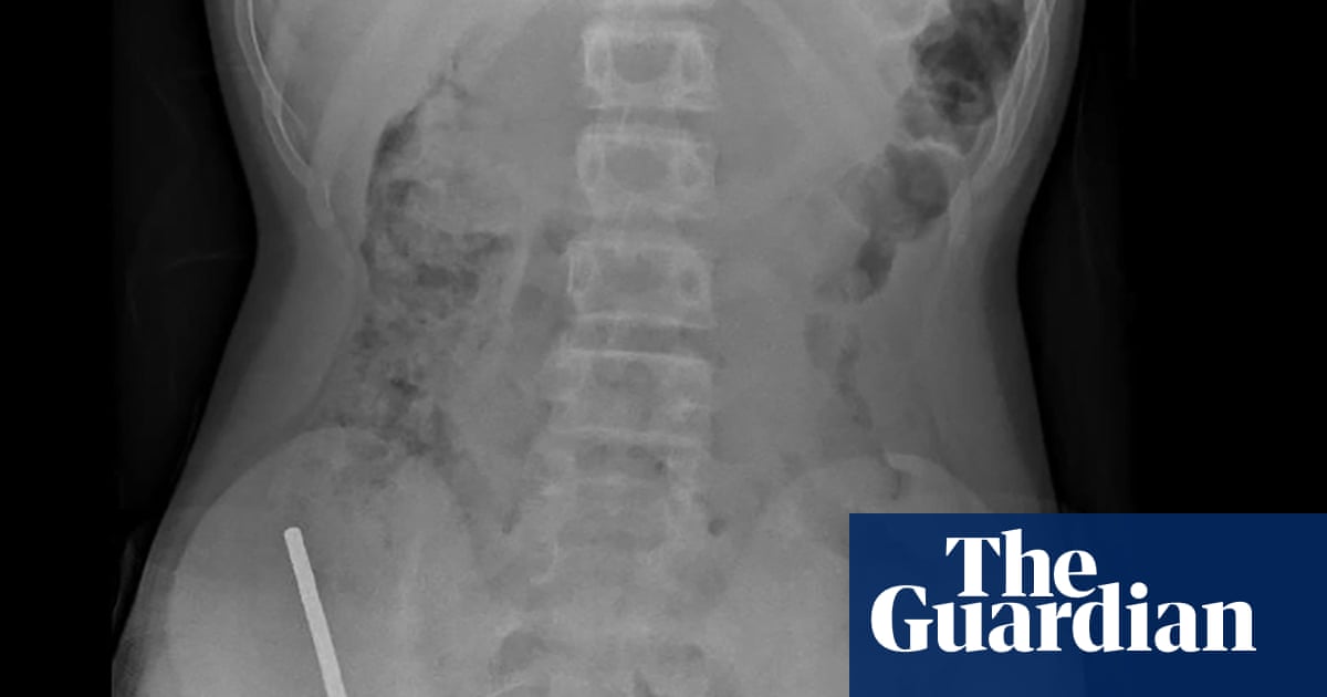 Surgeons remove up to 100 magnets from New Zealand teenager’s intestines | New Zealand