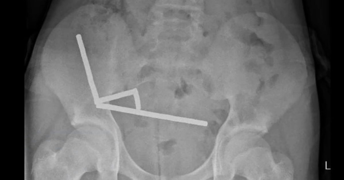 Boy who swallowed 100 magnets has surgery to remove them from his gut