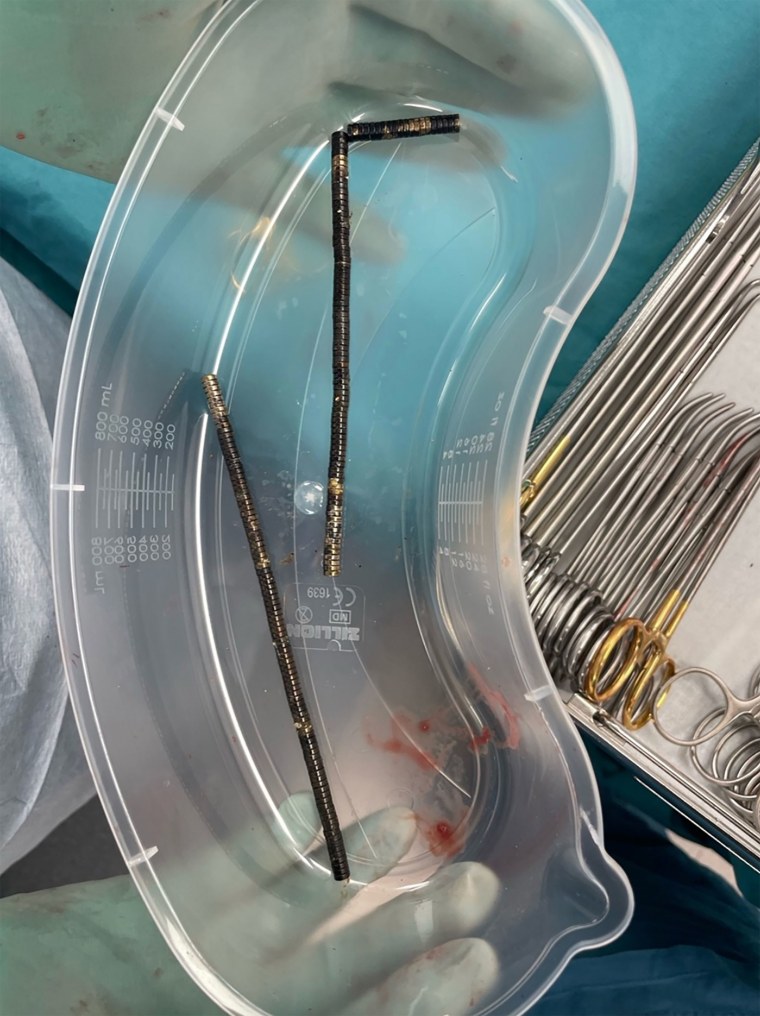 Approximately 80–100 high-powered magnets retrieved following surgery.