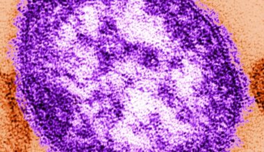 Alberta baby dies from measles - CTV News