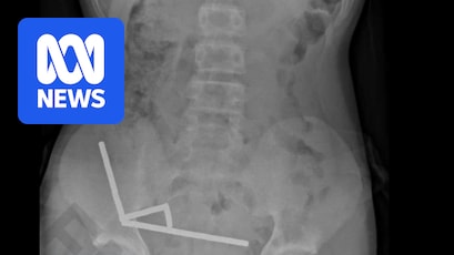 13-year-old has major surgery after eating 100 magnets bought on Temu