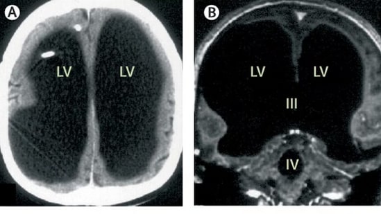 Brain scans from a 2007 study published in The Lancet revealed a French man's extraordinary condition, where his brain was severely compressed due to hydrocephalus, with only a thin layer of brain tissue remaining. (Pic courtesy: The Lancet)