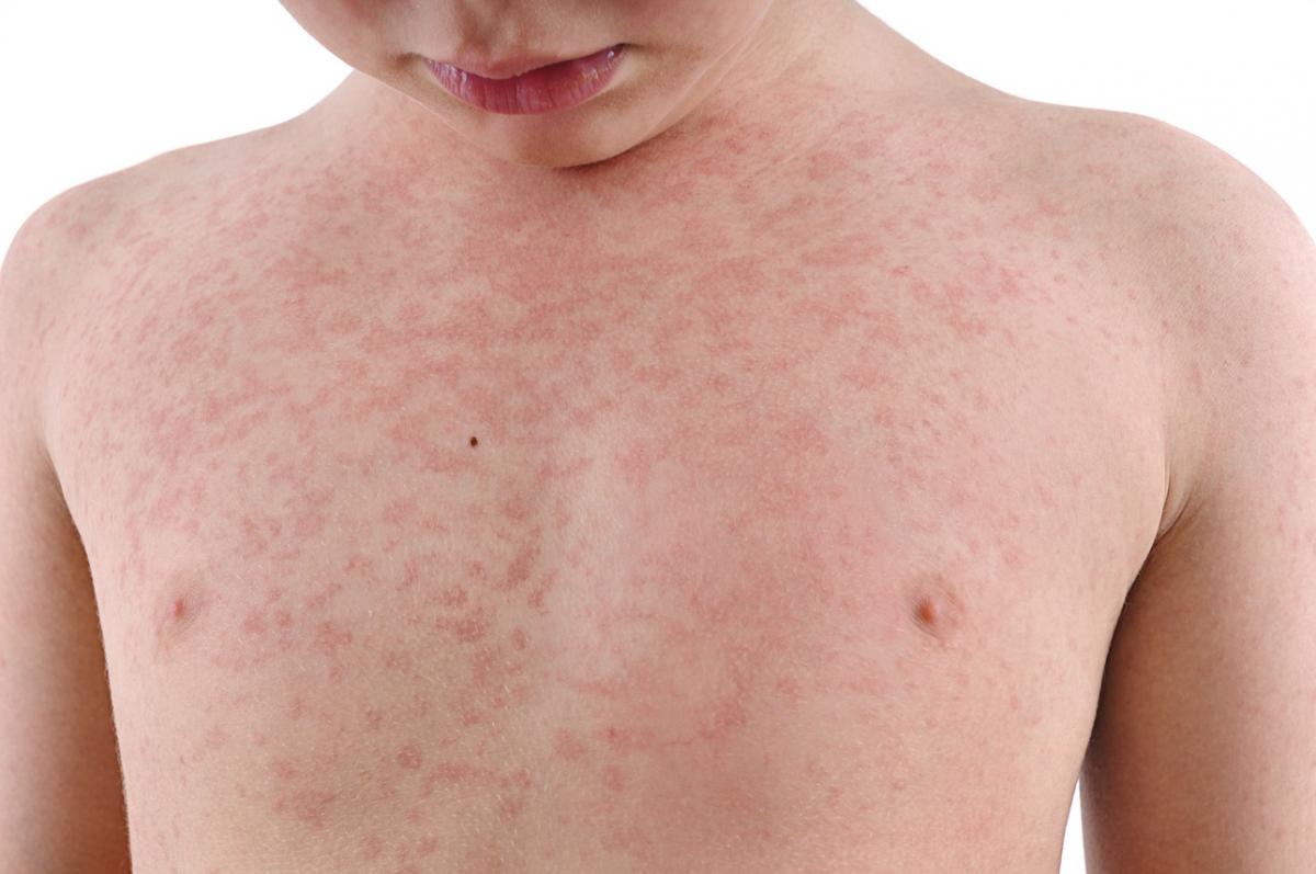 'Strong likelihood' measles spreading in the community