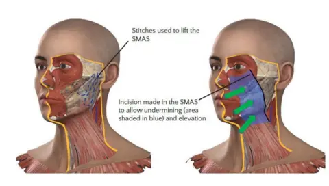 BAAPS A diagram showing how a facelift is carried out. There are two images of a face and neck with cross sections showing under the skin

This diagram shows how surgeons cut under several layers before reaching the deep plane which they reshape