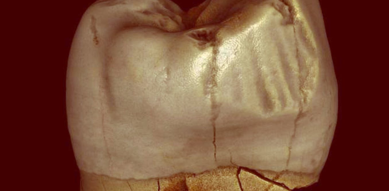 ‘Toothpick grooves’ in ancient fossil human teeth may not be from toothpicks after all