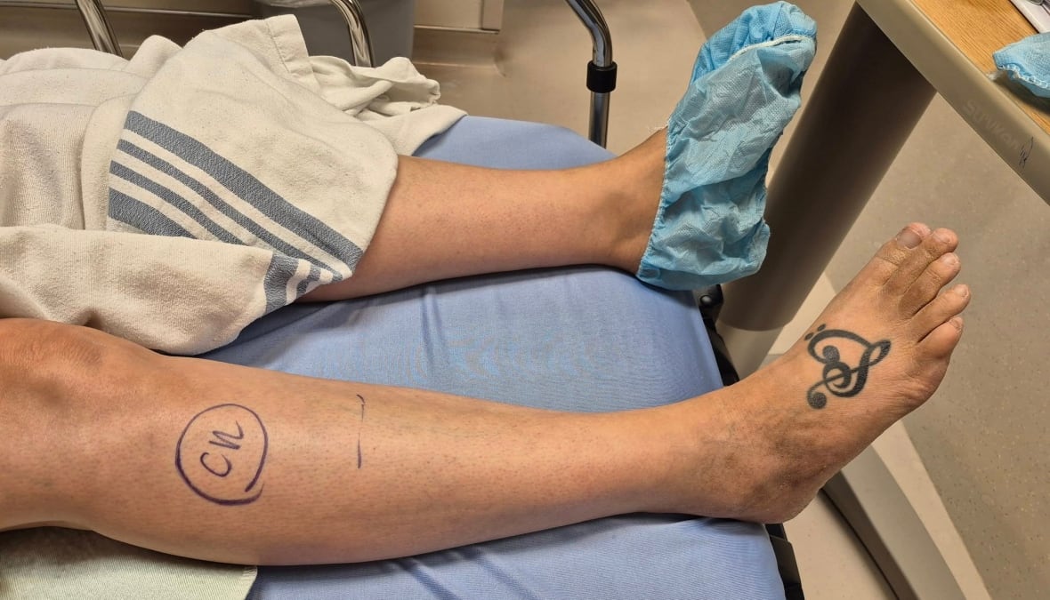 Two bare legs are seen in a hospital bed, the right one with a musical clef tattoo on the foot and a line indicating where a surgeon would cut. 