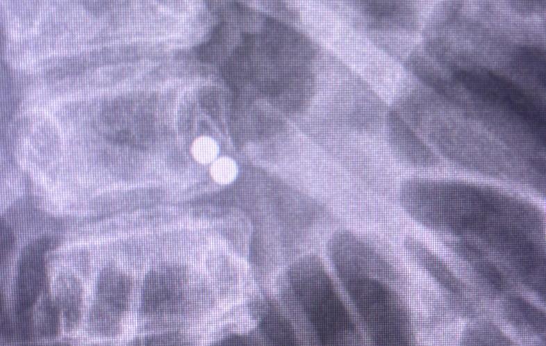 Surgery for boy who ate 100 magnets