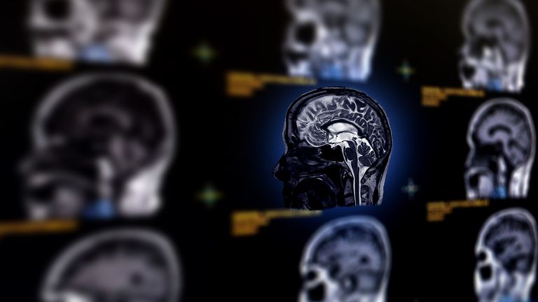 Brain aneurysms are common but often go undiagnosed. iStock file pic