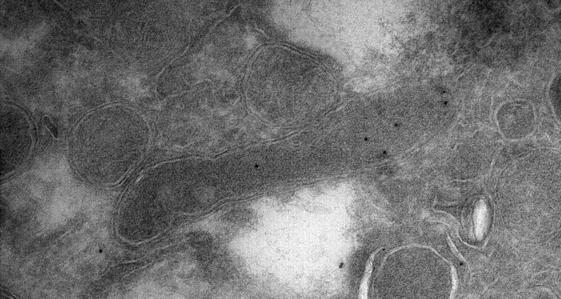 New study finds bacteria in brain tumors play 'surprising' role in cancer growth