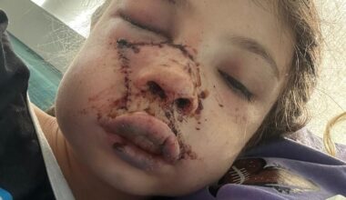 Delyla McCay: 9yo girl suffers horrific injuries after being mauled by blue heeler in Hanceville, Alabama