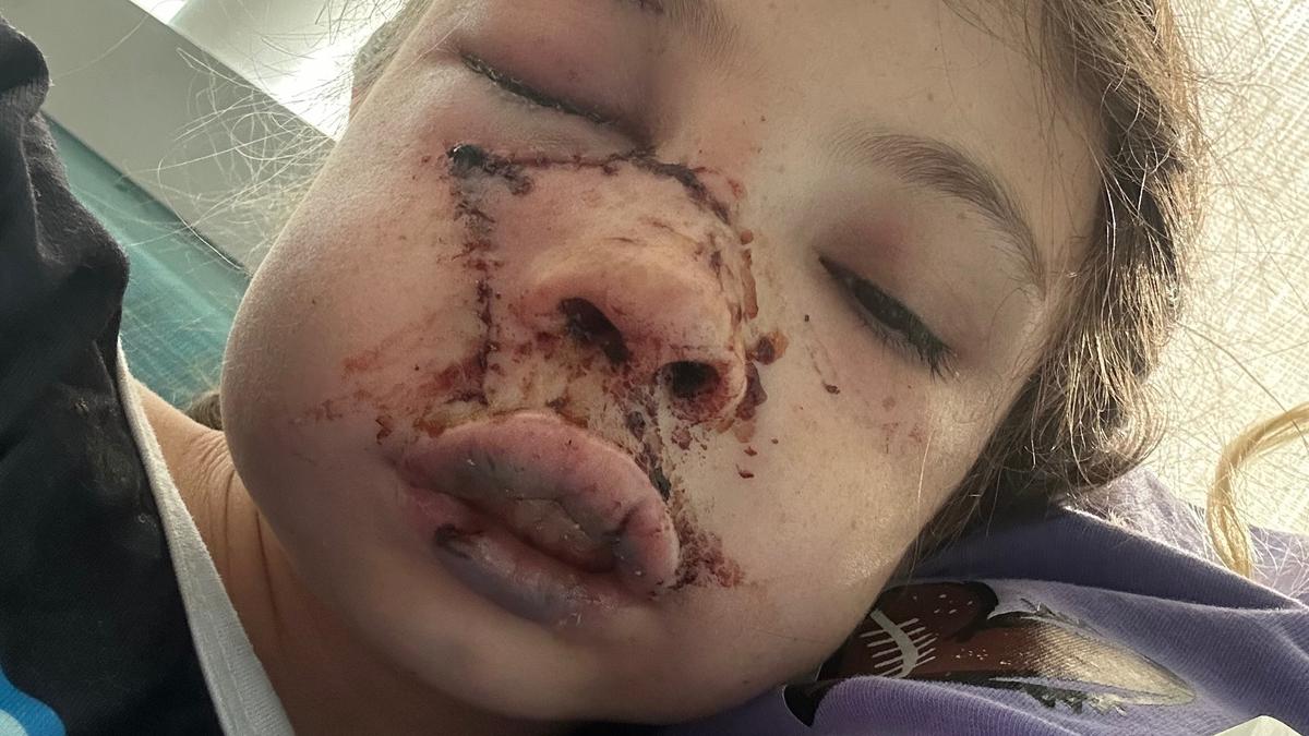 Delyla McCay: 9yo girl suffers horrific injuries after being mauled by blue heeler in Hanceville, Alabama