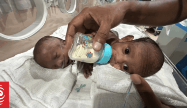 Critical assessment underway for PNG's conjoined twins by Australian doctors